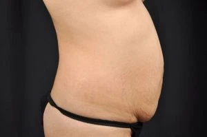Tummy Tuck