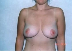 Breast Lift
