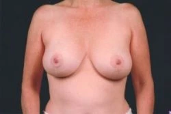 Breast Lift