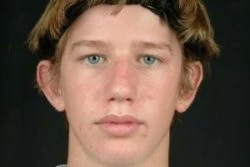 Otoplasty (Ear Tuck)