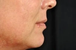 Injectable Fillers Virginia Beach