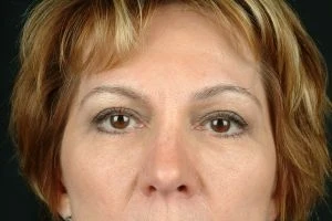 Injectable Fillers