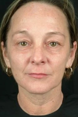 Laser Skin Rejuvenation