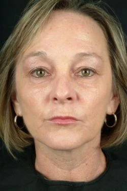 Laser Skin Rejuvenation