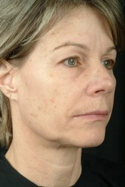 Laser Skin Rejuvenation