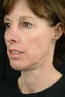 Laser Skin Rejuvenation