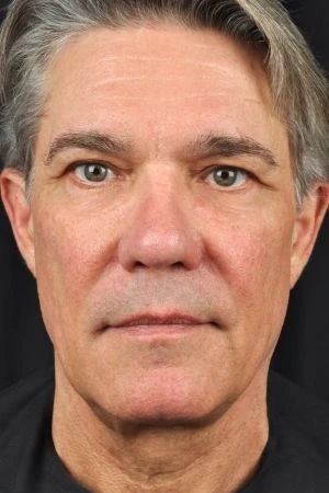 Sculptra Aesthetic Results Virginia Beach