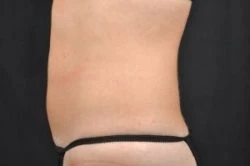 CoolSculpting