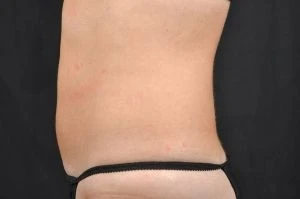 CoolSculpting