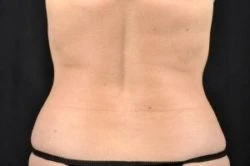 CoolSculpting