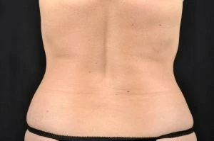 CoolSculpting