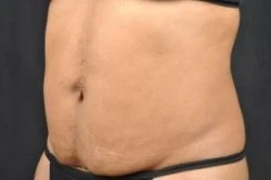 CoolSculpting