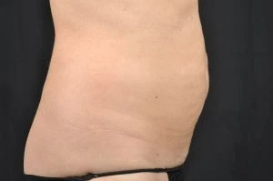 CoolSculpting