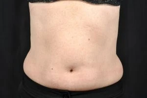 CoolSculpting Before