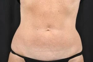 CoolSculpting After