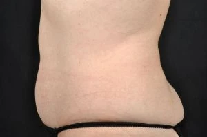CoolSculpting
