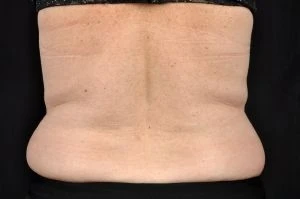 CoolSculpting