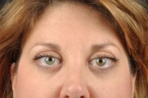 Botox Cosmetic after photo